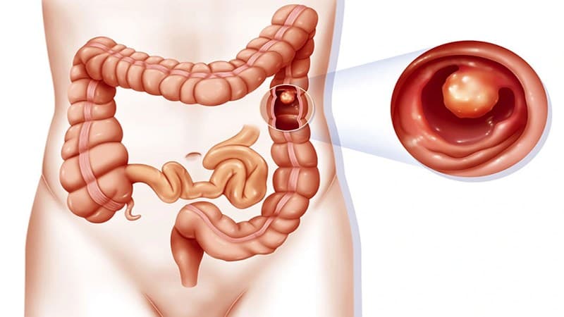 điều trị polyp đại tràng ác tính