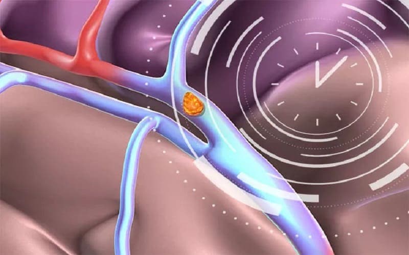 tiêu sợi huyết trong nhồi máu não