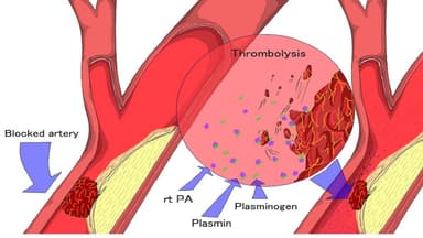 Tiêu sợi huyết trong nhồi máu não như thế nào?