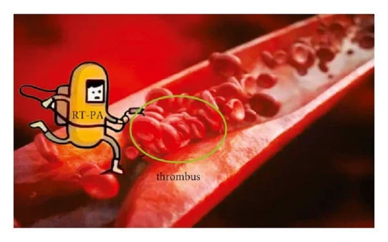 tiêu sợi huyết trong nhồi máu não