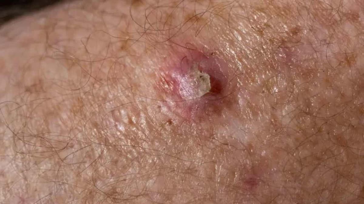 Tổn thương tế bào nội biểu mô vảy độ thấp