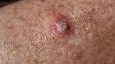 Tổn thương tế bào nội biểu mô vảy độ thấp