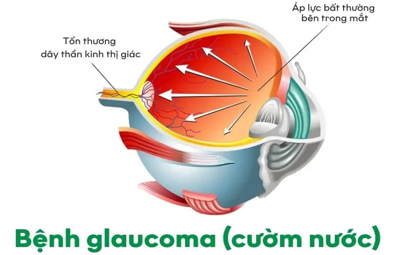 thuốc hạ nhãn áp travatan