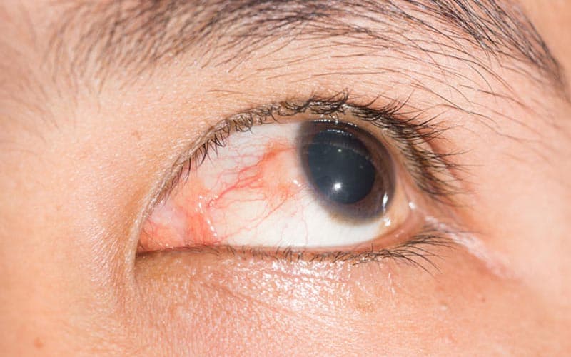 thuốc hạ nhãn áp travatan