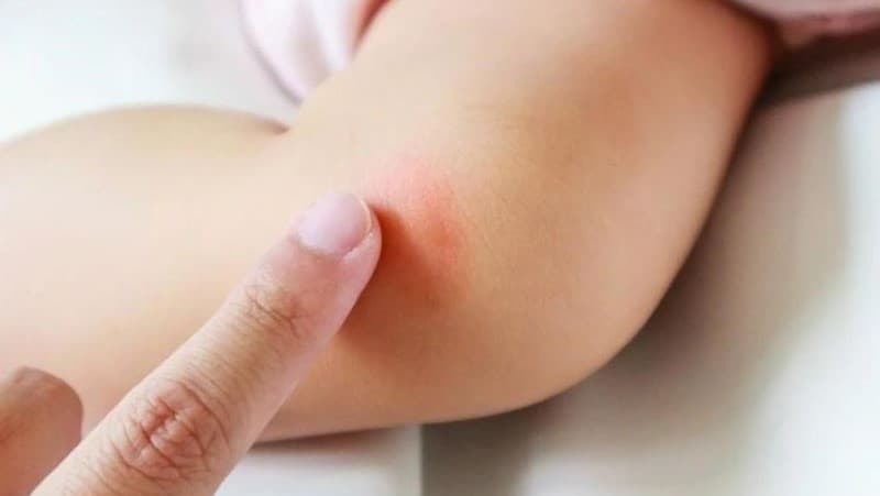 trẻ sơ sinh bị muỗi đốt bôi dầu tràm