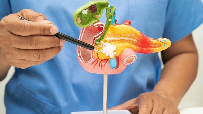 u cơ tuyến túi mật