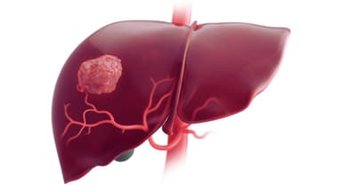 Ung thư tế bào gan nguyên phát có nguy hiểm?