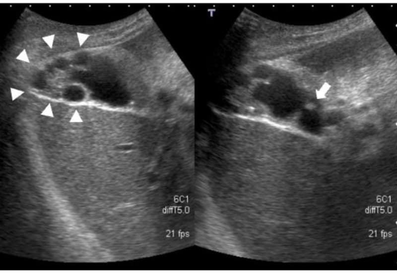 u cơ tuyến túi mật