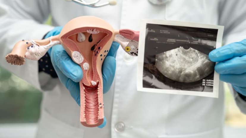 U xơ tử cung chèn ép bàng quang thế nào?