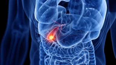 Ung thư đường mật có di truyền không?