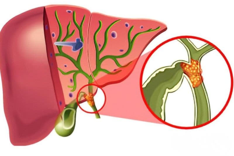 ung thư đường mật giai đoạn 4