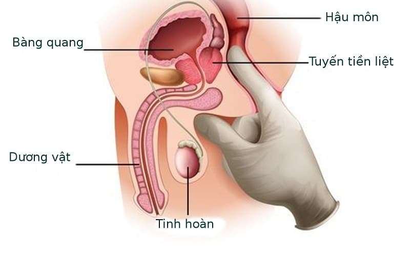 dấu hiệu ung thư tuyến tiền liệt ở nam