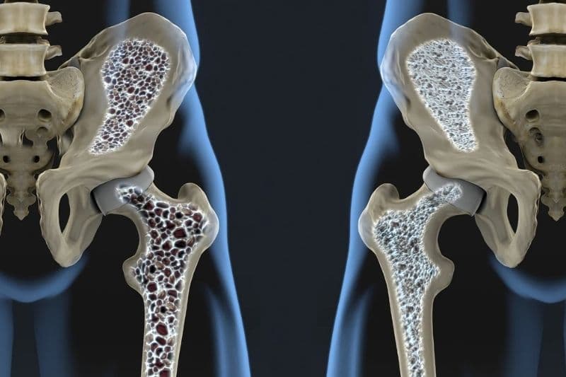 biến chứng xương trong điều trị ung thư tiền liệt tuyến