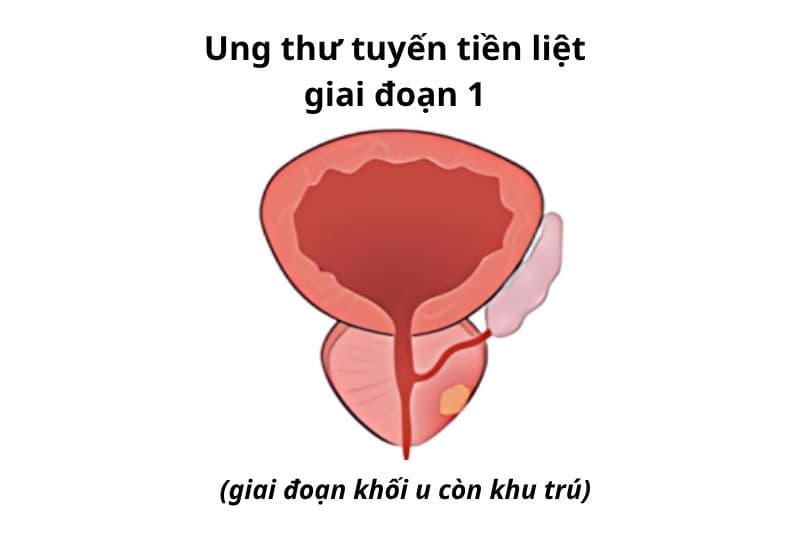 giai đoạn ung thư tiền liệt tuyến