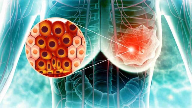 Ung thư vú bao lâu thì phát bệnh?