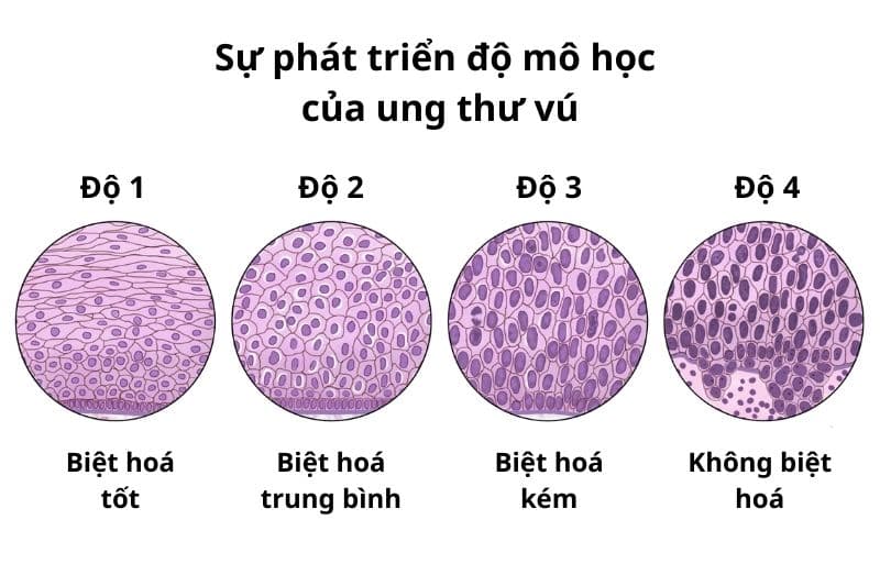 ung thư vú bao lâu thì phát bệnh