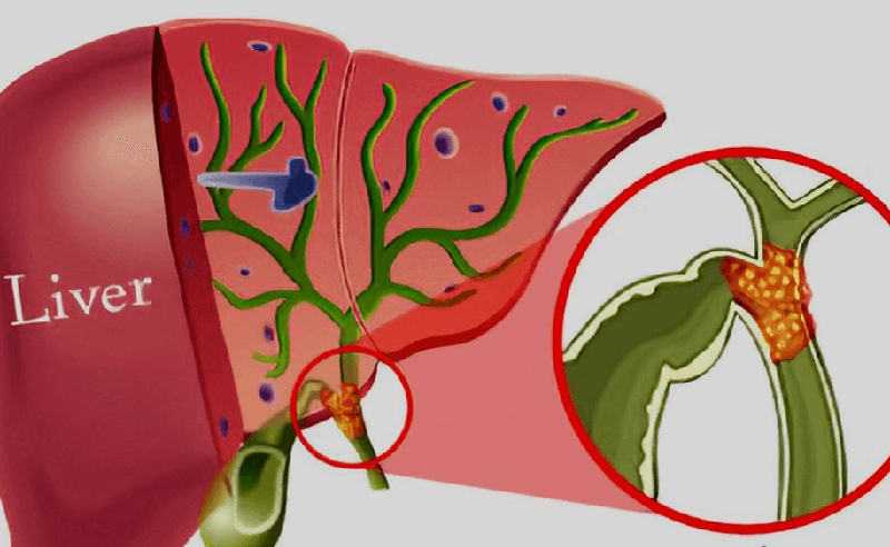 các giai đoạn của ung thư đường mật trong gan