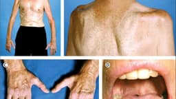 Xơ cứng cột bên teo cơ là bệnh gì?