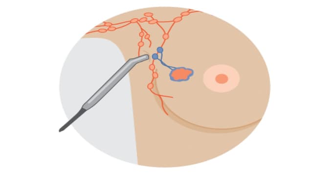Các yếu tố nguy cơ ung thư vú