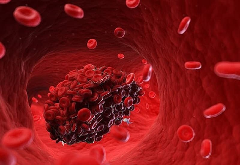 dấu hiệu có cục máu đông trong não