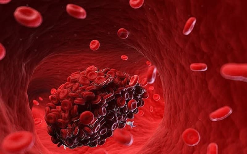 cục máu đông trong não có nguy hiểm không