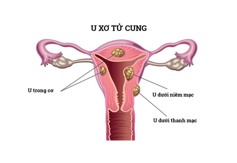 ăn gì để giảm kích thước u xơ tử cung