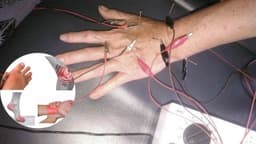 Điện châm điều trị viêm khớp dạng thấp