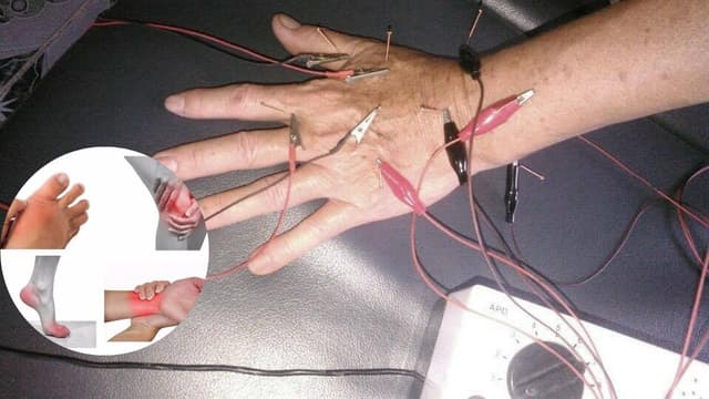 Điện châm điều trị viêm khớp dạng thấp