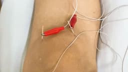 Điện châm trong điều trị thoái hoá khớp gối