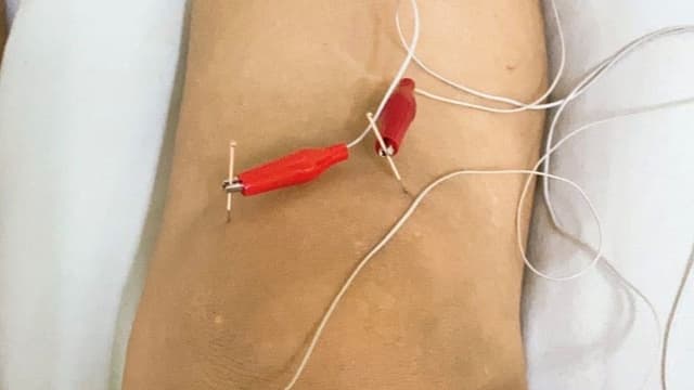 Điện châm trong điều trị thoái hoá khớp gối