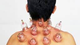 Giác hơi giảm đau vai gáy không?