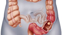 Polyp đại tràng tăng sản là gì? Có nhìn rõ dưới siêu âm được không?