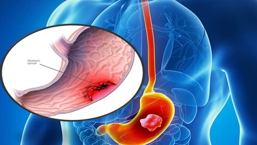 Bao nhiêu tuổi nên tầm soát ung thư tiêu hóa?