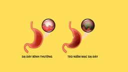 Teo niêm mạc dạ dày có nguy hiểm không?