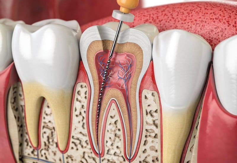 bà bầu có nên đặt thuốc diệt tủy răng