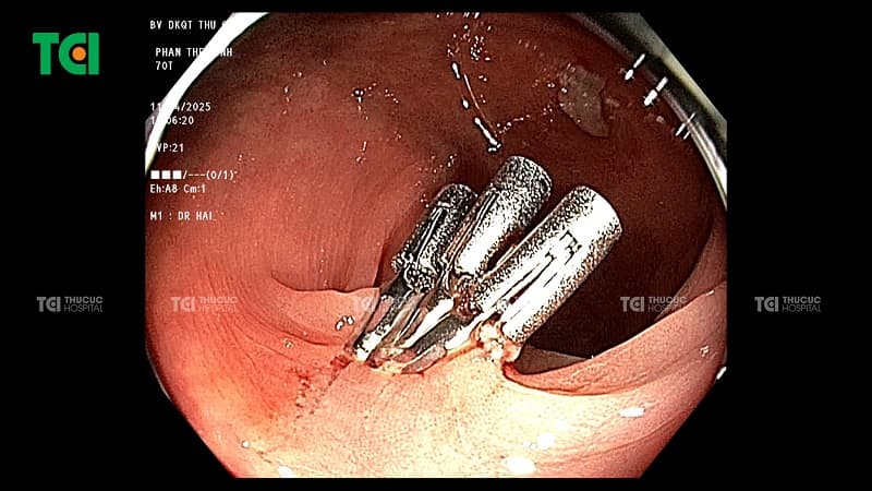 polyp đại tràng sigma 5mm