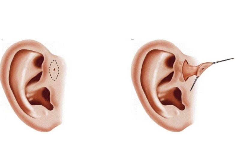 bệnh rò luân nhĩ ở người lớn