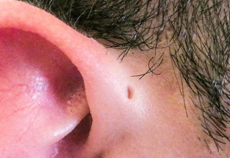 bệnh rò luân nhĩ ở người lớn