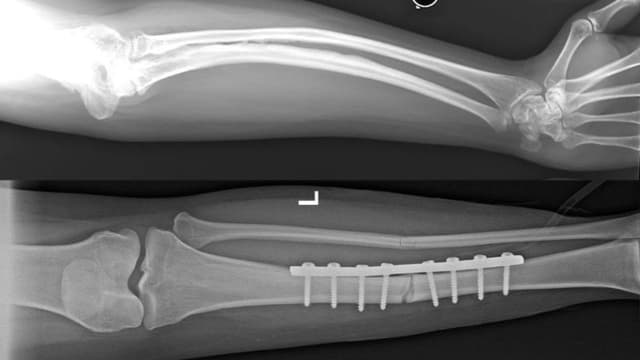 Bệnh xương thủy tinh – Bắt nguồn từ đâu