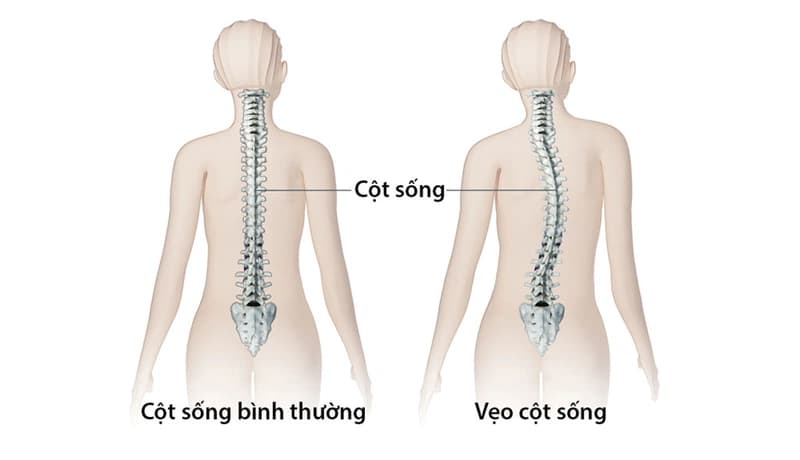 Bệnh xương thủy tinh - Bắt nguồn từ đâu