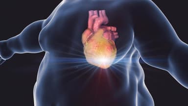 Béo phì có gây đột quỵ không?