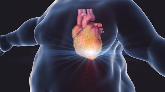 Béo phì có gây đột quỵ không?