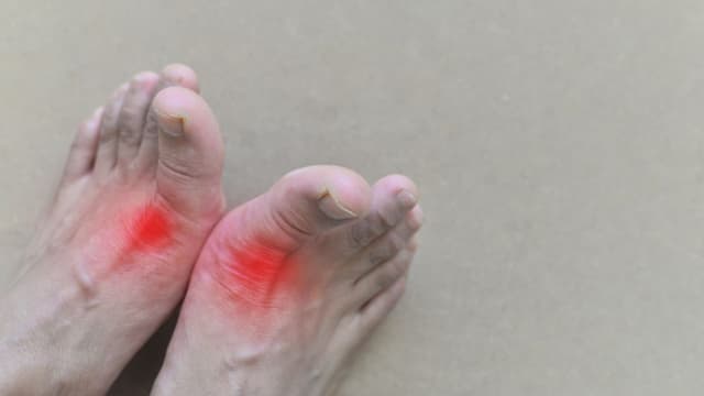 Bị gút có uống dầu cá được không?
