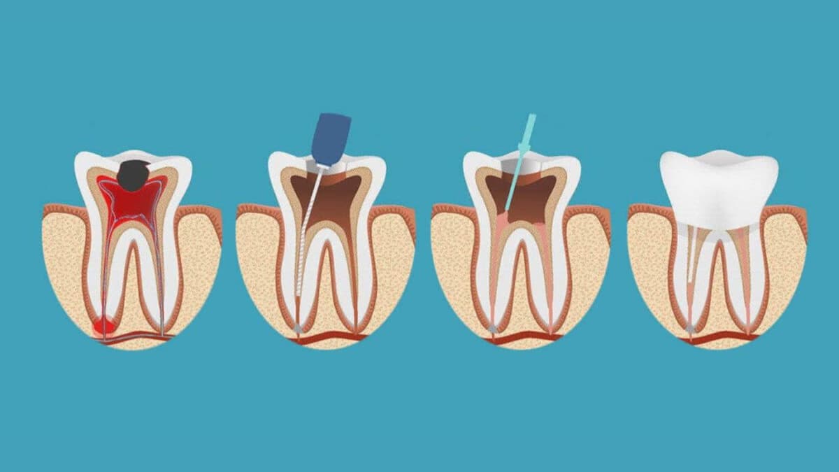 Các bước diệt tủy răng chuẩn y khoa