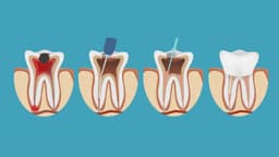 Các bước diệt tủy răng chuẩn y khoa