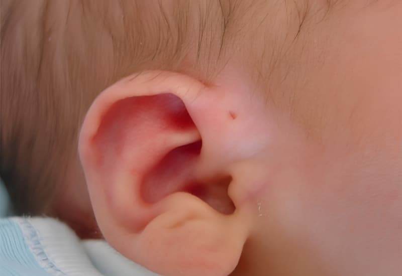 các vị trí rò luân nhĩ