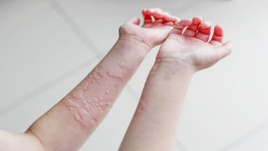 Các cách trị mề đay bằng dân gian