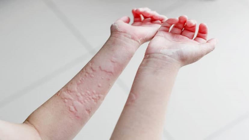 Các cách trị mề đay bằng dân gian