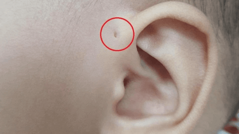 cách vệ sinh lỗ rò luân nhĩ