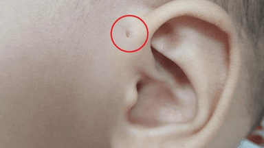 Cách vệ sinh lỗ rò luân nhĩ